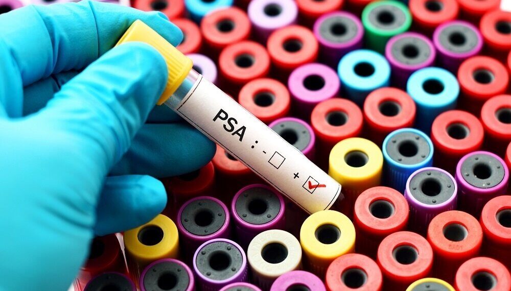 Prostate Cancer Screening Rates Lower With Advanced Cancers