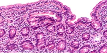 FDA grants fast track designation to ImmusanTs vaccine for celiac disease