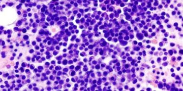 AbbVie and Teneobio Announce a Strategic Transaction to Develop a New Treatment for Multiple Myeloma