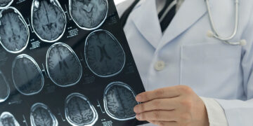 Alzheimers Disease Can Be Diagnosed By A Single Brain Scan