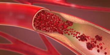 Blood Vessel Route- Major Discovery In Alzheimers Treatment